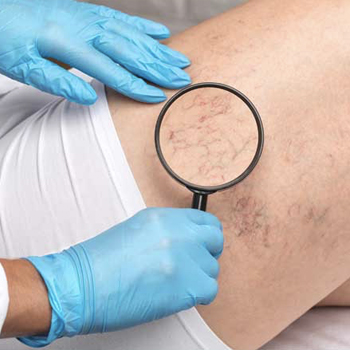 DermVA - Spider Vein Bubble